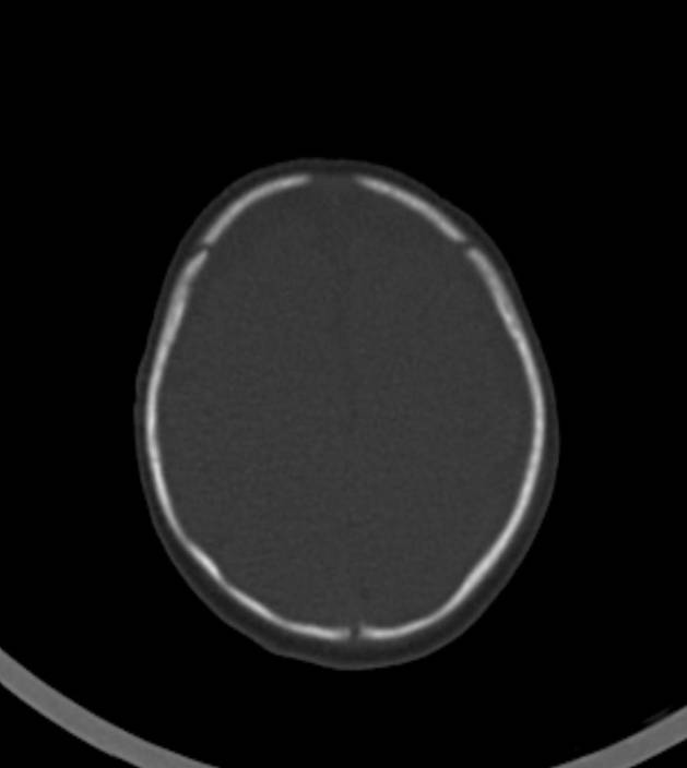 Normal brain CT - 2-month-old (Radiopaedia 53369-59350 Axial bone window 12).jpg