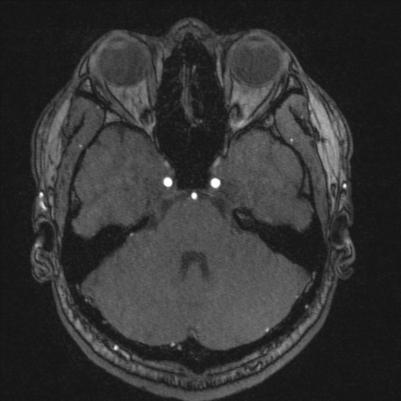 Normal brain MRI including MRA (Radiopaedia 48748-53763 Axial MRA 55).jpg