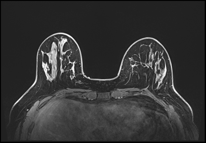 Normal breast MRI - dense breasts (Radiopaedia 80454-93850 C 70).jpg