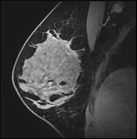 Normal breast MRI - dense breasts (Radiopaedia 80454-93850 I 79).jpg