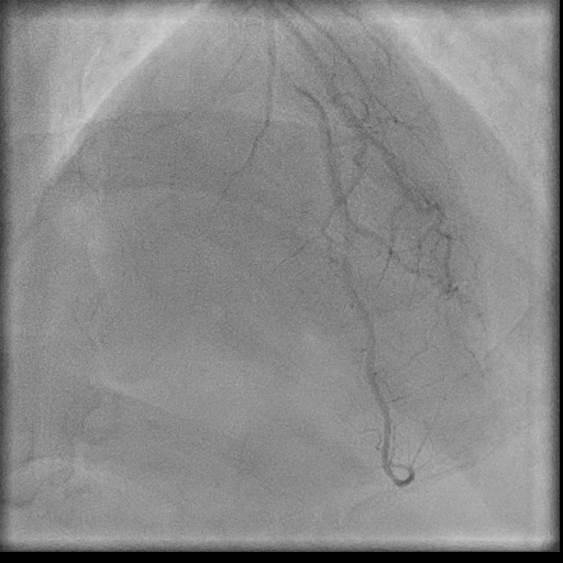 Normal coronary angiogram (DSA) (Radiopaedia 63081-71571 E 79).jpg
