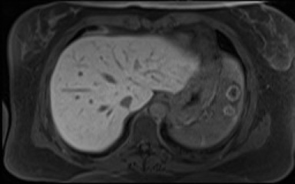 File:Normal hepatobiliary phase liver MRI (Radiopaedia 58968-66230 A 23).jpg