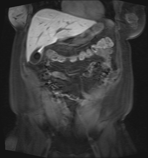 File:Normal hepatobiliary phase liver MRI (Radiopaedia 58968-66230 B 37).jpg