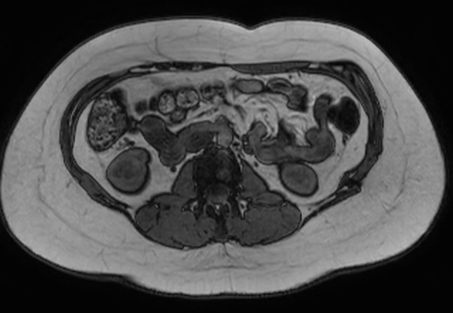 File:Normal liver MRI with Gadolinium (Radiopaedia 58913-66163 B 8).jpg