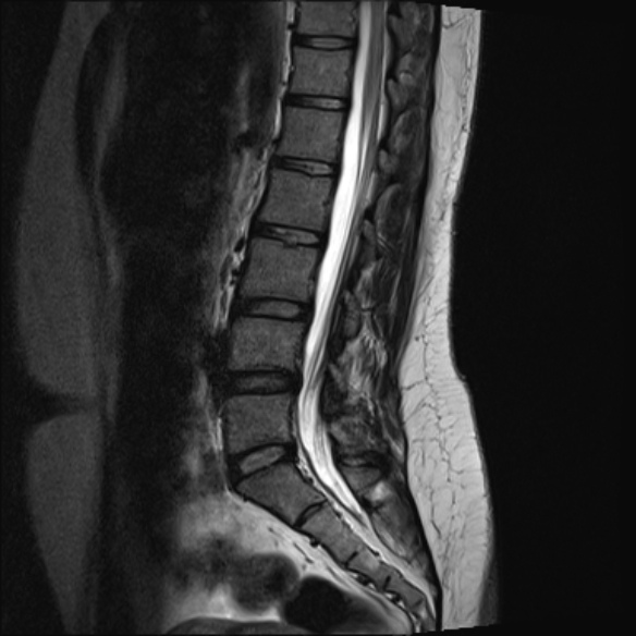 File:Normal lumbar spine MRI- 3 T (Radiopaedia 53280-59250 Sagittal T2 12).jpg