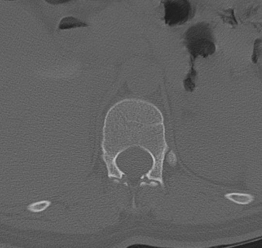 File:Normal lumbosacral CT (Radiopaedia 37923-39867 Axial bone window 19).png