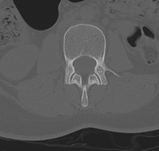 File:Normal lumbosacral CT (Radiopaedia 37923-39867 Axial bone window 49).png