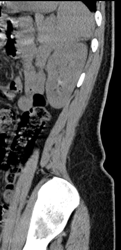 Normal lumbosacral CT (Radiopaedia 37923-39867 E 16).png