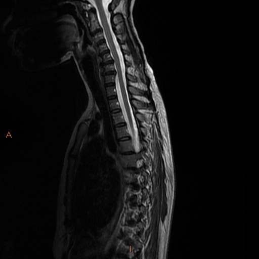 File:Normal spine MRI (Radiopaedia 77323-89408 E 8).jpg