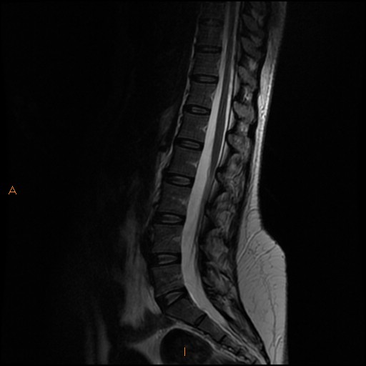 File:Normal spine MRI (Radiopaedia 77323-89408 Sagittal T2 7).jpg