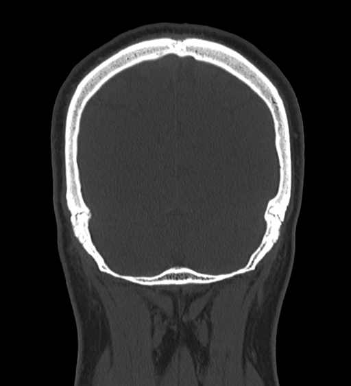 Occipital spur and Currarino type A atlas anomaly (Radiopaedia 87027-103285 Coronal bone window 119).jpg