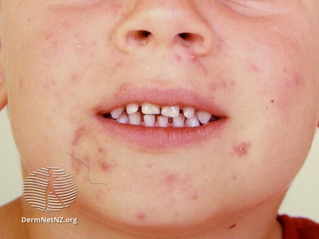 File:Prepubertal acne (DermNet NZ acne-infantile-acne1).jpg