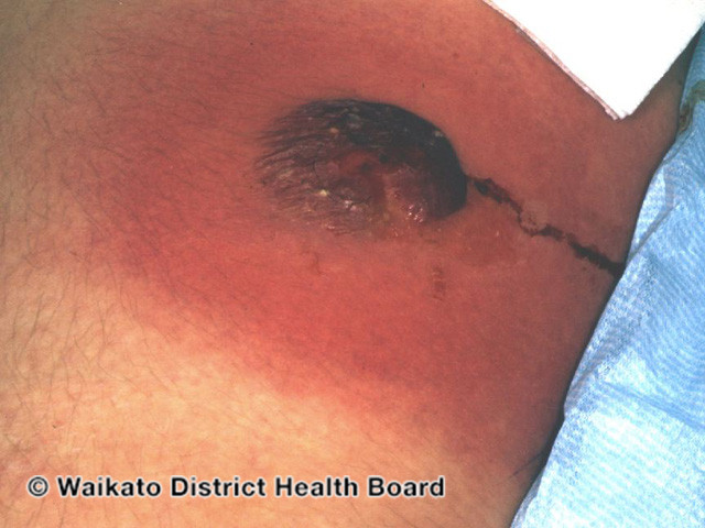 File:Wound infection (DermNet NZ bacterial-w-abscess-6).jpg