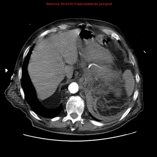 File:Abdominal aortic aneurysm- extremely large, ruptured (Radiopaedia 19882-19921 Axial C+ arterial phase 12).jpg
