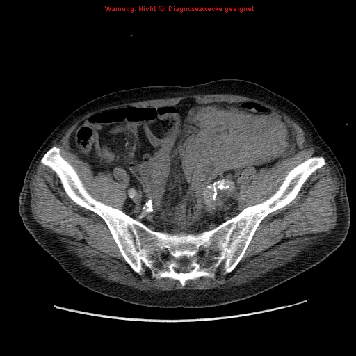 Abdominal aortic aneurysm- extremely large, ruptured (Radiopaedia 19882-19921 Axial C+ arterial phase 61).jpg