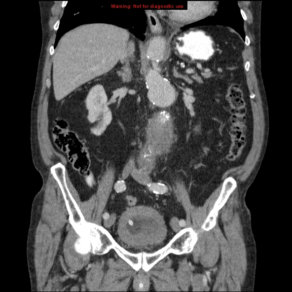File:Abdominal aortic aneurysm (Radiopaedia 10122-10660 Coronal C+ portal venous phase 25).jpg
