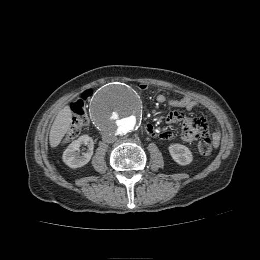 Abdominal aortic aneurysm (Radiopaedia 13341-13340 Axial C+ arterial phase 105).jpg