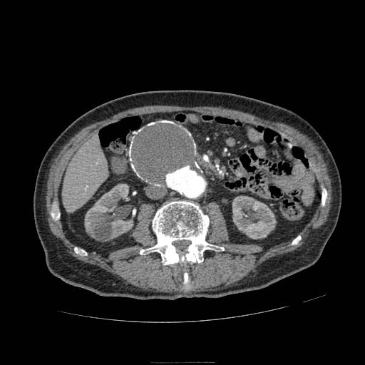 Abdominal aortic aneurysm (Radiopaedia 13341-13340 Axial C+ arterial phase 93).jpg