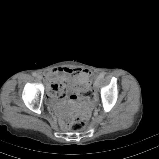 File:Abdominal aortic aneurysm (Radiopaedia 20827-20742 Axial C+ delayed 32).jpg