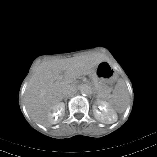 File:Abdominal aortic aneurysm (Radiopaedia 20827-20742 Axial C+ delayed 7).jpg