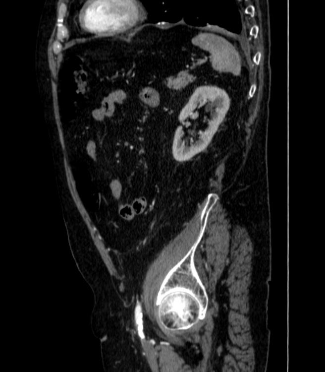 Abdominal aortic aneurysm (Radiopaedia 25855-26001 Sagittal C+ arterial phase 61).jpg