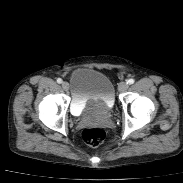 Abdominal aortic aneurysm (Radiopaedia 29248-29660 Axial C+ arterial phase 85).jpg