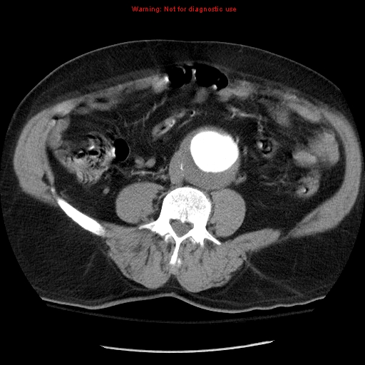 Abdominal aortic aneurysm (Radiopaedia 8190-9038 Axial C+ arterial phase 49).jpg