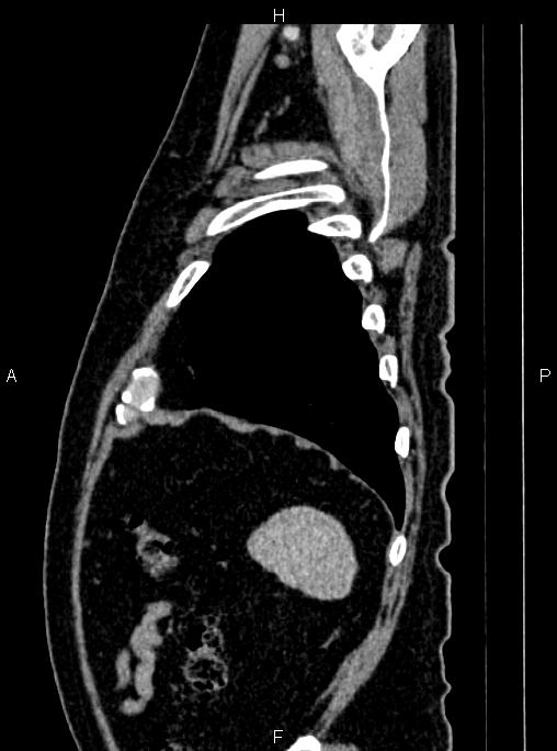 Abdominal aortic aneurysm (Radiopaedia 83094-97462 Sagittal renal cortical phase 107).jpg