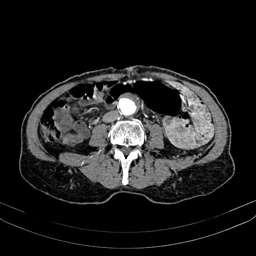 Abdominal aortic aneurysm (Radiopaedia 83581-98689 Axial C+ arterial phase 69).jpg
