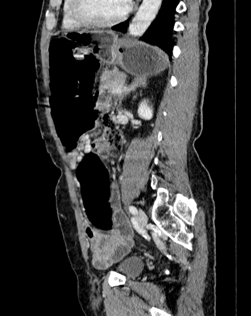 Abdominal aortic aneurysm (Radiopaedia 83581-98689 Sagittal C+ portal venous phase 79).jpg