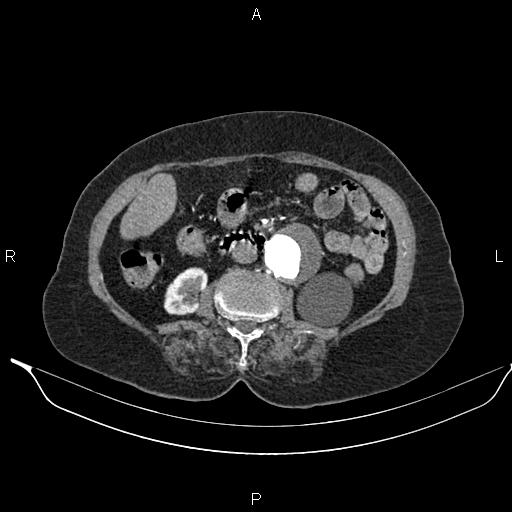 File:Abdominal aortic aneurysm (Radiopaedia 85063-100606 Axial C+ arterial phase 40).jpg