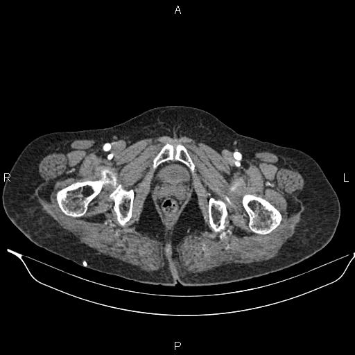 File:Abdominal aortic aneurysm (Radiopaedia 85063-100606 Axial C+ arterial phase 66).jpg