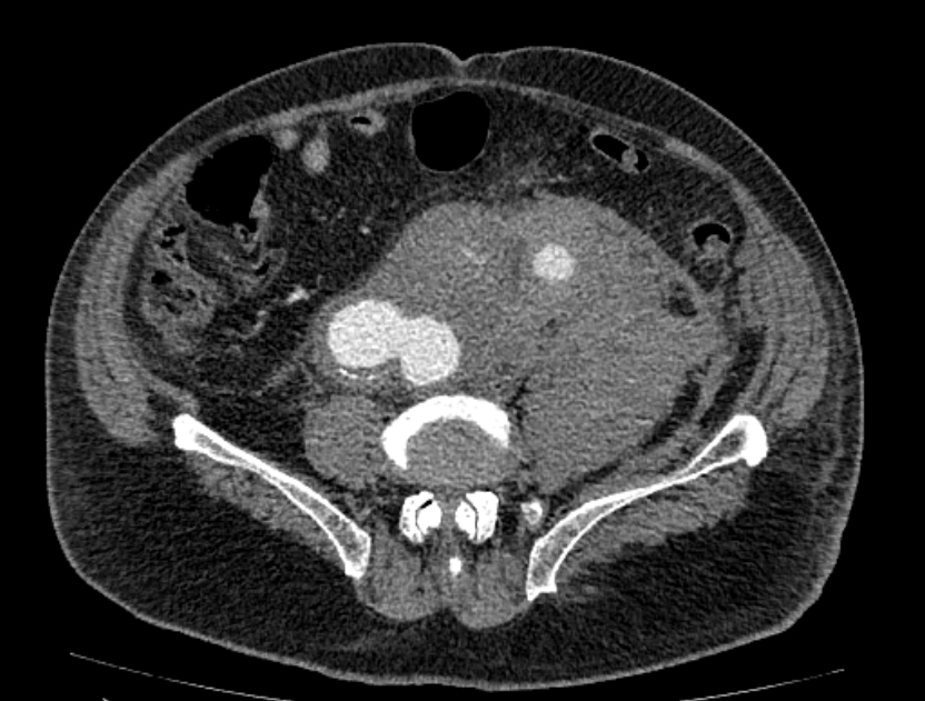 Abdominal aortic aneurysm rupture (Radiopaedia 54179-60362 Axial C+ portal venous phase 13).jpg