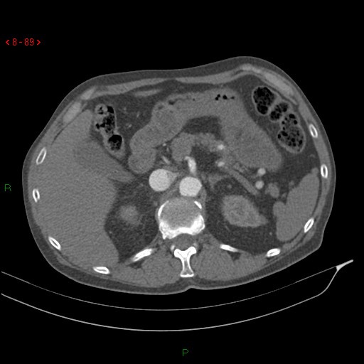 Abdominal aortic aneurysm rupture with aortocaval fistula (Radiopaedia 14897-14841 Axial C+ arterial phase 89).jpg
