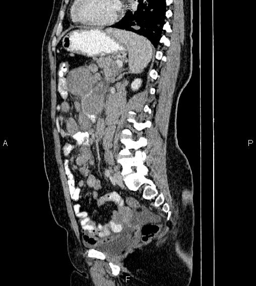 Abdominal lymphoma with sandwich sign (Radiopaedia 84378-99704 Sagittal C+ portal venous phase 56).jpg