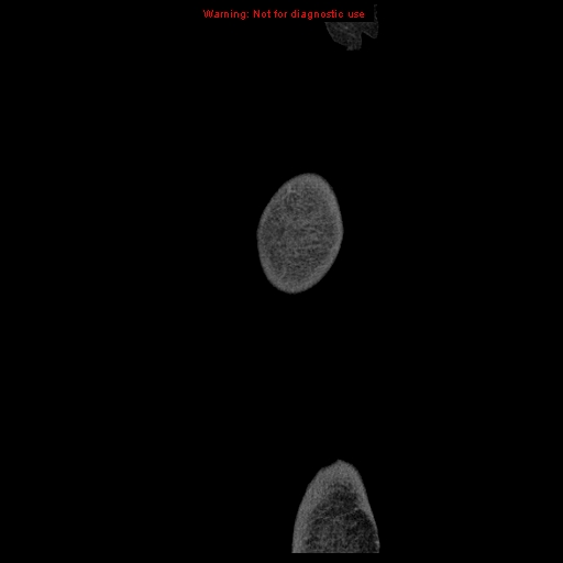 Abdominal wall hematoma (Radiopaedia 9427-10112 Sagittal C+ portal venous phase 116).jpg