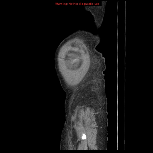 Abdominal wall hematoma (Radiopaedia 9427-10112 Sagittal C+ portal venous phase 8).jpg