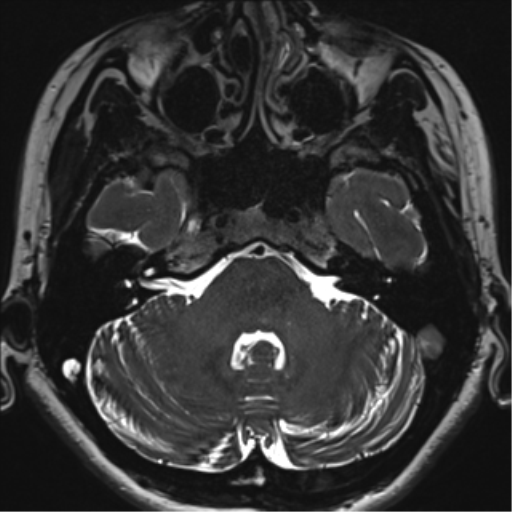 Abducens nerve palsy (Radiopaedia 51069-56648 Axial T2 fat sat 25).png