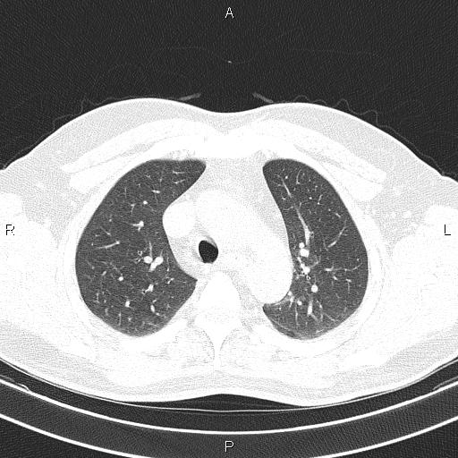 Aberrant right subclavian artery (Radiopaedia 87093-103354 Axial lung window 33).jpg
