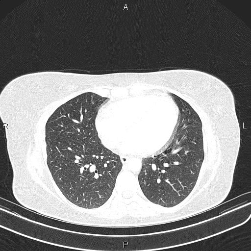 Aberrant right subclavian artery (Radiopaedia 87334-103629 Axial lung window 43).jpg