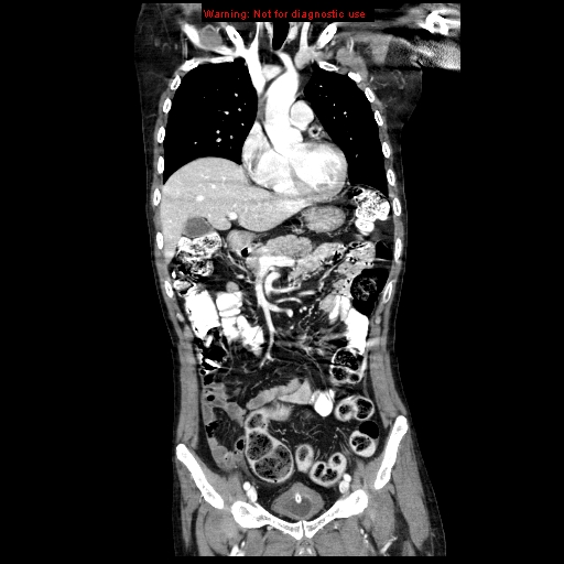 File:Aberrant right subclavian artery (Radiopaedia 9379-10071 Coronal C+ arterial phase 3).jpg