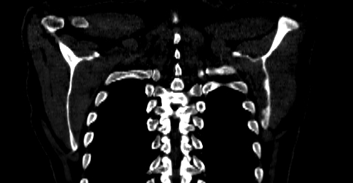 Accesory rib joint (Radiopaedia 71987-82452 Coronal bone window 68).jpg