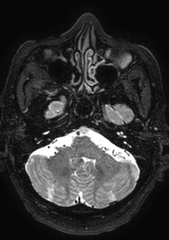 Accessory middle cerebral artery (Radiopaedia 73114-83828 Axial T2 175).jpg