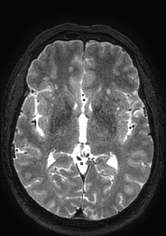 Accessory middle cerebral artery (Radiopaedia 73114-83828 Axial T2 76).jpg