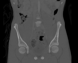 File:Acetabular fracture (Radiopaedia 13285-13288 Coronal bone window 1).jpg