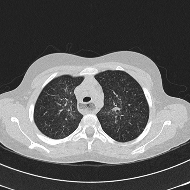 Achalasia (Radiopaedia 14946-14878 Axial lung window 17).jpg