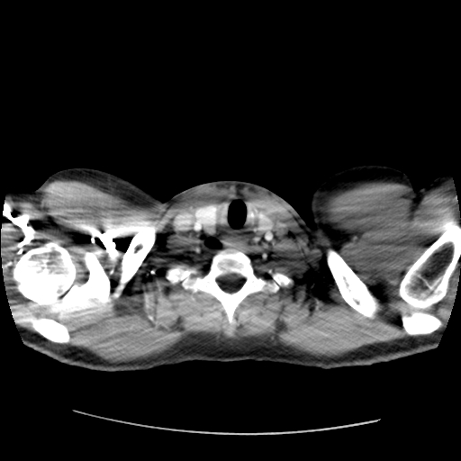 Achalasia (Radiopaedia 52507-58417 Axial bone window 2).jpg