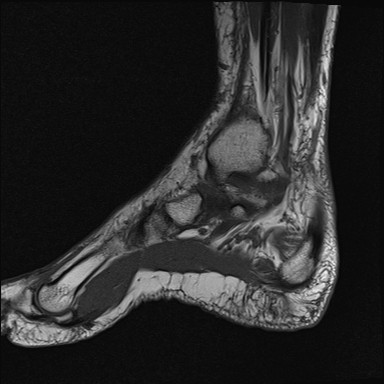 File:Achilles tendon tear (Radiopaedia 77615-89819 Sagittal T1 5).jpg