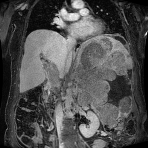 Acinar cell carcinoma of the pancreas (Radiopaedia 75442-86668 Coronal T1 C+ fat sat 98).jpg