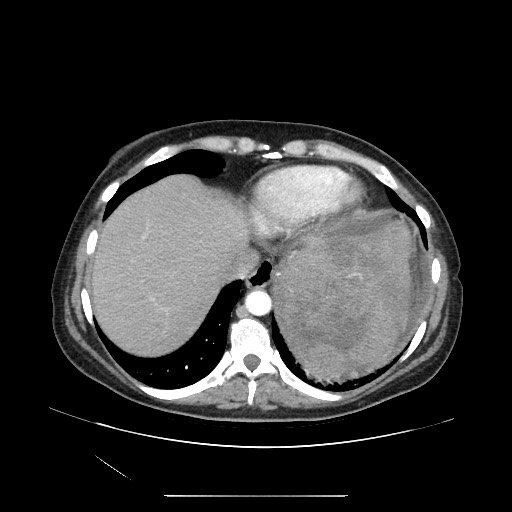 Acinar cell carcinoma of the pancreas (Radiopaedia 75442-86669 Axial C+ portal venous phase 14).jpg